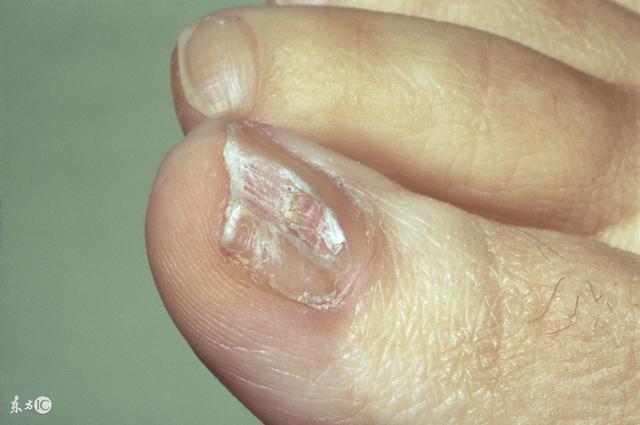 灰指甲是什么症状(如果出现这3个症状)(4)