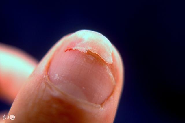 灰指甲是什么症状(如果出现这3个症状)(2)