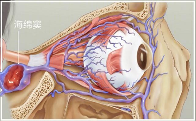 挖鼻孔导致颅内感染儿童（8岁娃颅内感染竟是因为）(10)