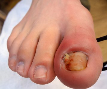 ​脚趾甲沟炎怎么办 甲沟炎的处理方法