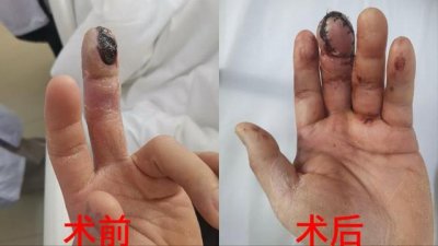 ​龙虾爱好者请注意！长沙一男子被龙虾壳刺伤，感染后皮肤软组织坏死