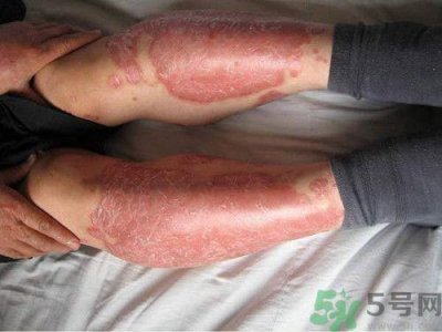 ​紫外线过敏怎么办?紫外线过敏能根治吗