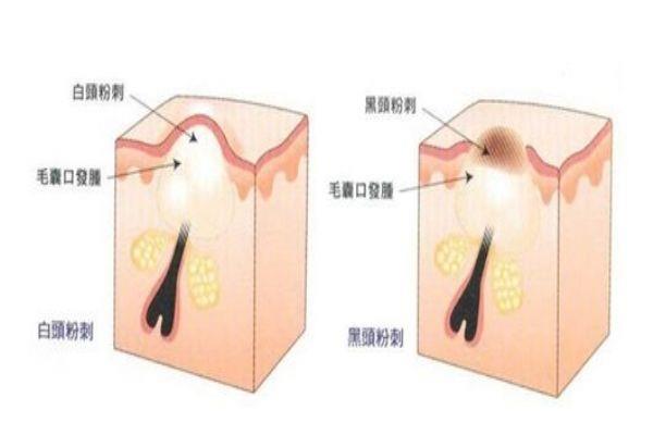 如何去除下巴上的粉刺 清洁补水控油三部曲 如何去除下巴上的粉刺 清洁补水控油三部曲