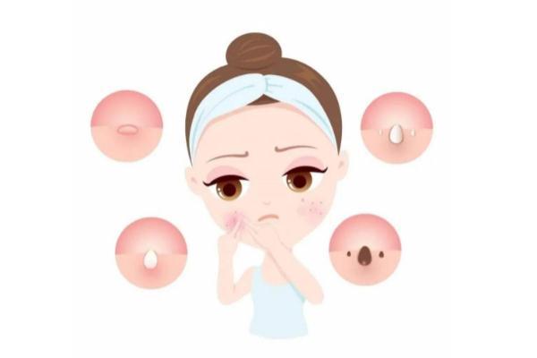 青春痘有哪几种类型 青春痘有脓包怎么办 青春痘有哪几种类型 青春痘有脓包怎么办