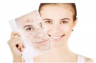 ​为什么脸上会长包呢 长包的原因是什么呢