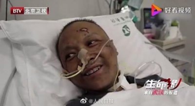 ​武汉中心医院易凡医生已出院，曾全身变黑！人工肺维持一个多月
