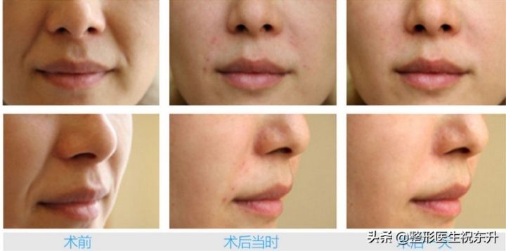 什么是法令纹图片（图文讲解3种不同的法令纹现状）