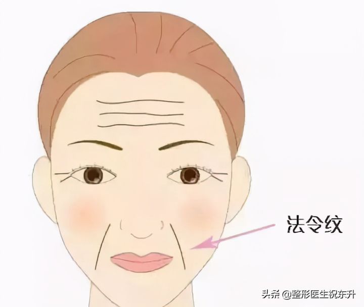 什么是法令纹图片（图文讲解3种不同的法令纹现状）