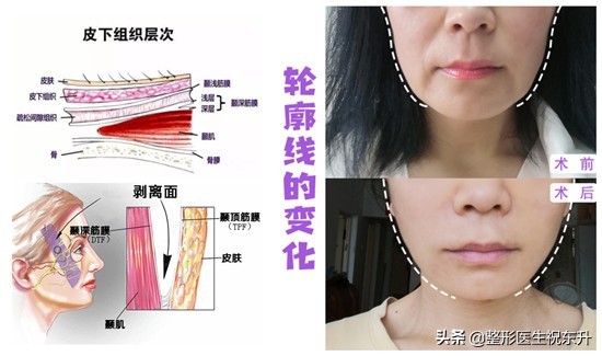 什么是法令纹图片（图文讲解3种不同的法令纹现状）